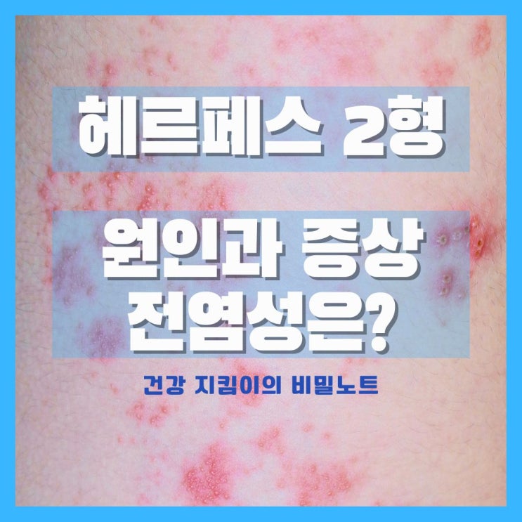  여자 성병 헤르페스 2형 원인과 증상 전염 알아보기