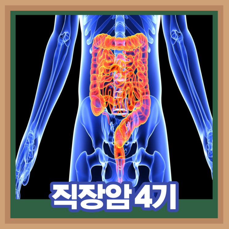  직장암 원인 초기 증상 치료 4기 생존율 예방법