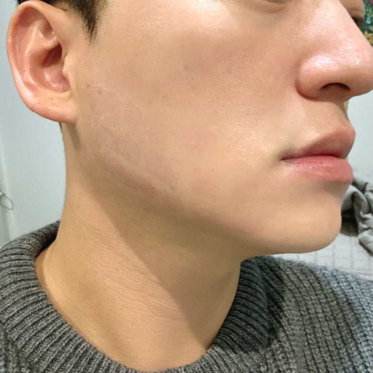 포텐자 모공레이저 청담피부과에서 시술 후기 포텐자 모공레이저 청담피부과에서 시술 후기