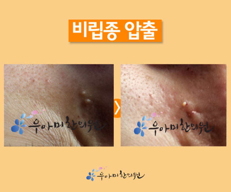 눈앞 눈가 눈밑 비립종 제거 피부과 눈가 레이저로 흉터가 남았다면?(압출)