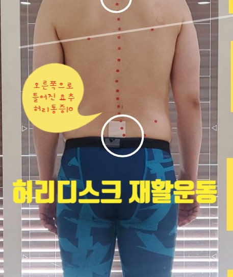  2번 수술한 허리디스크??다시수술을 할까??(부산동래구사직동디스크재활)