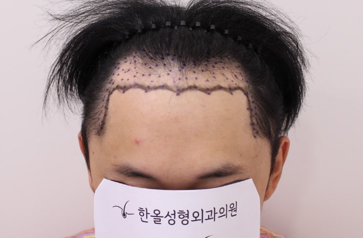  한올성형외과 30대 남성 헤어라인 수술 1일차