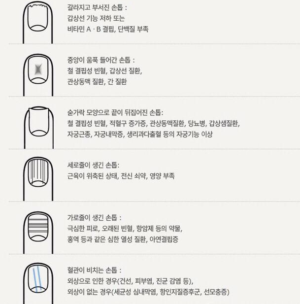  손톱검은세로줄 손톱세로줄 생기는 이유 4가지
