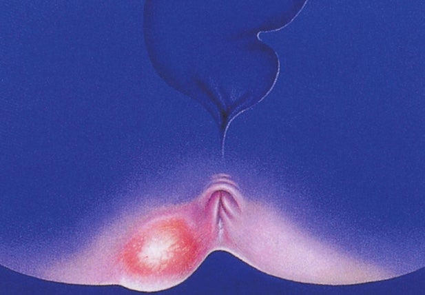 울산 항사랑병원 (치질, 치루, 항문농양) 수술 후 4~6일차