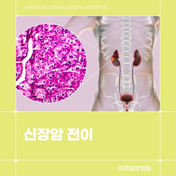 신장암 전이 예방하려면