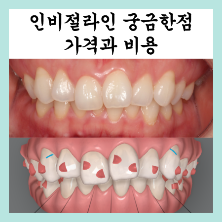  인비절라인 궁금했던 점들, 비용에 대해서