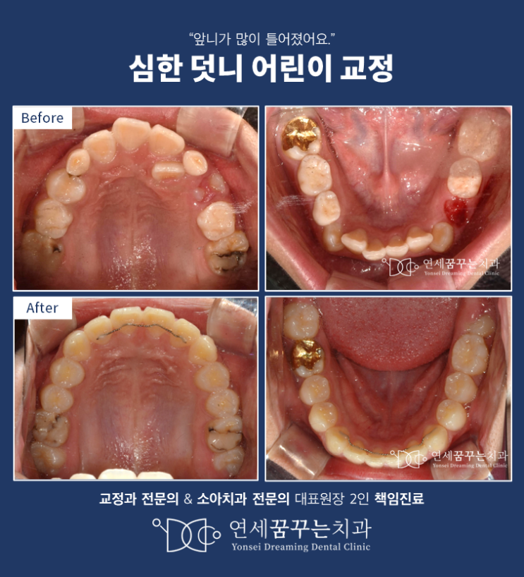 양평 심한 덧니 교정, 발치 없이 어린이 교정으로 해결하기! know-how