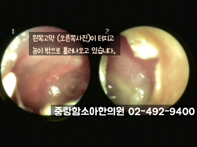중이염 고막 터짐 : 어떻게 해야 되나요? (중랑 함소아한의원)