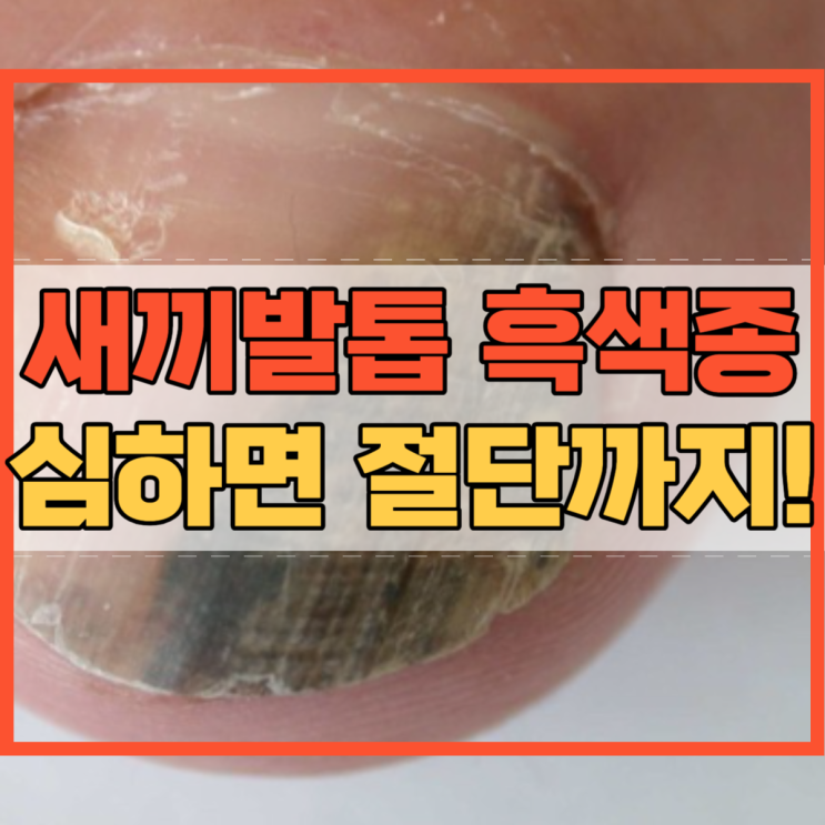  새끼발톱 흑색종 심하면 절단까지!