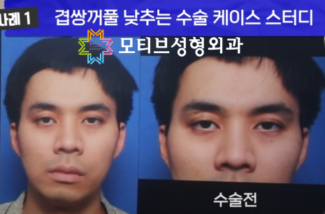 겹쌍꺼풀없애기 , 쌍꺼풀낮추기 전후사진 케이스 스터디!