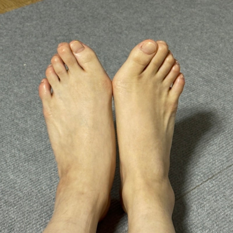 무지외반증 수술 후기 (대구-서울/양발 수술준비/24살)
