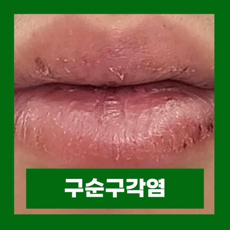  입술 옆 찢어짐 구순구각염 원인 치료 연고