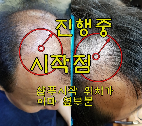  유형별 탈모 종류