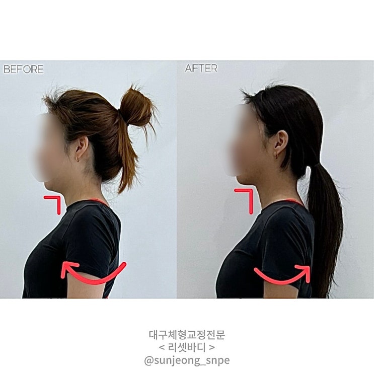  대구 침산동 SNPE 리셋바디 거북목 라운드숄더 교정 체험사례/대구거북목/대구라운드숄더