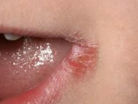 구순염, 구각염 - 입술 가장자리가 따가운건 왜일까요? 교정치료 중 입술 끝이 갈라지고 아프다면?