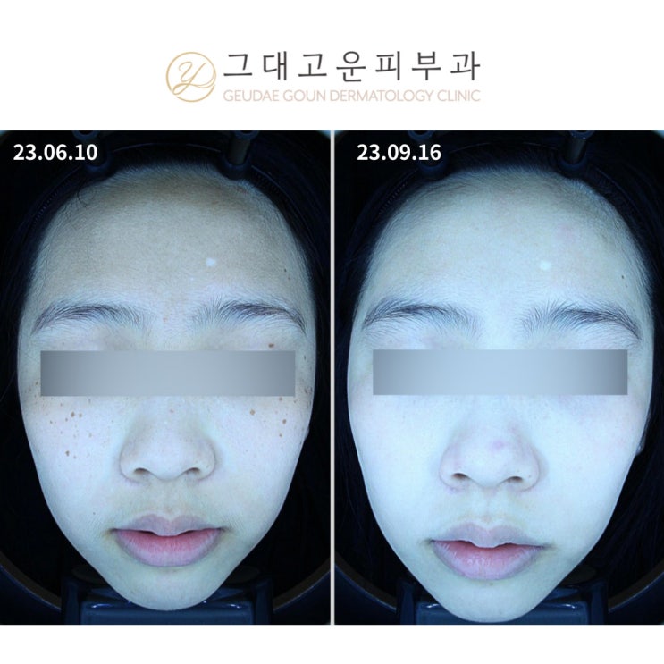 부산 주근깨? 제대로 알고 치료하셔야 합니다. 부산 주근깨? 제대로 알고 치료하셔야 합니다.