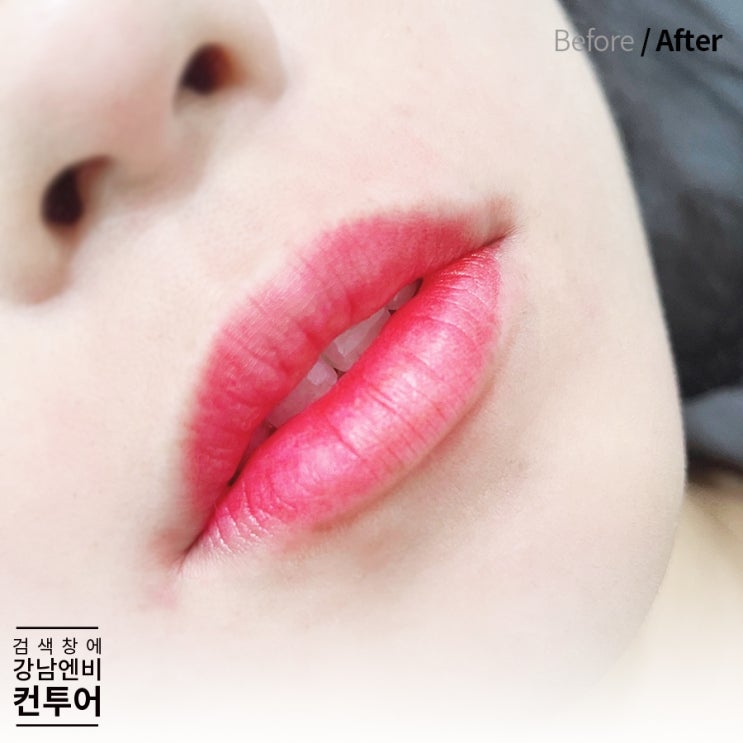  강남입술반영구 염증이 생기는 이유와 주의사항