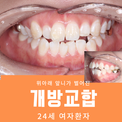  위아래 앞니가 벌어진 '개방교합' /24세 여자 환자