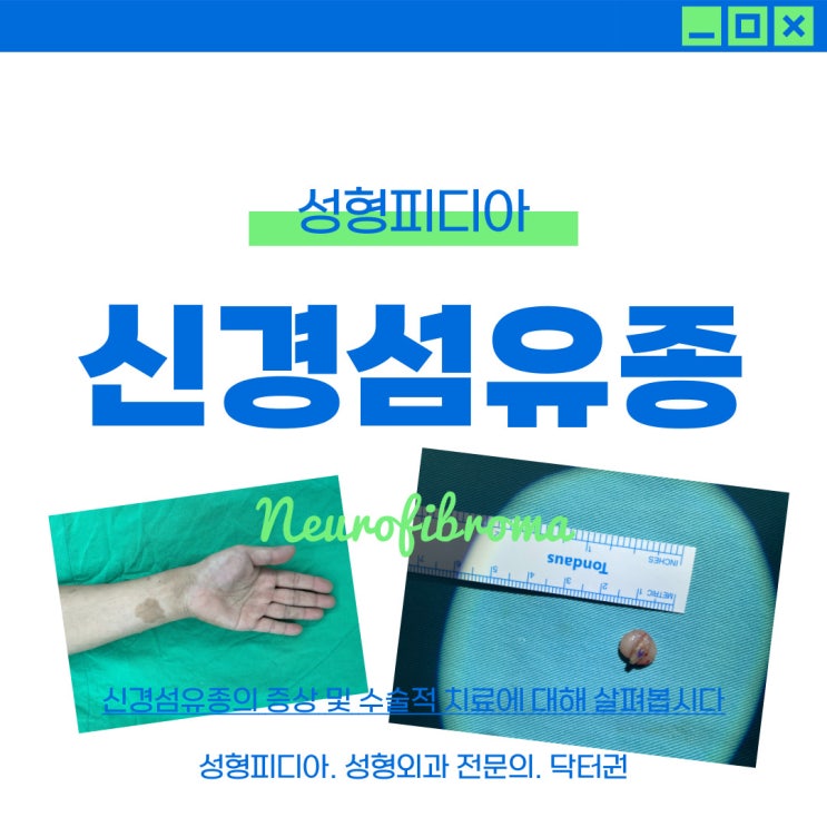  [양성종양] 신경섬유종 제거 수술은 어떻게 하나요? (feat. 성형외과 전문의)