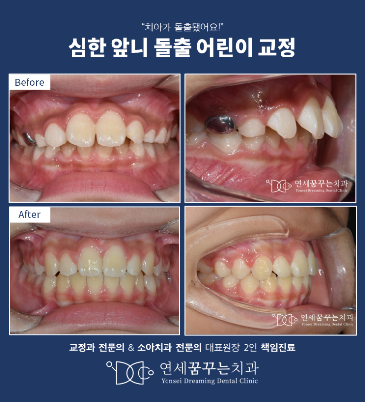 하남 어린이 돌출, 어린이 교정(성장기교정)으로 발치 없이 치료하기!