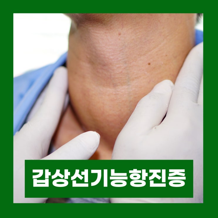  갑상선기능항진증 원인 증상 진단 치료 그레이브스병