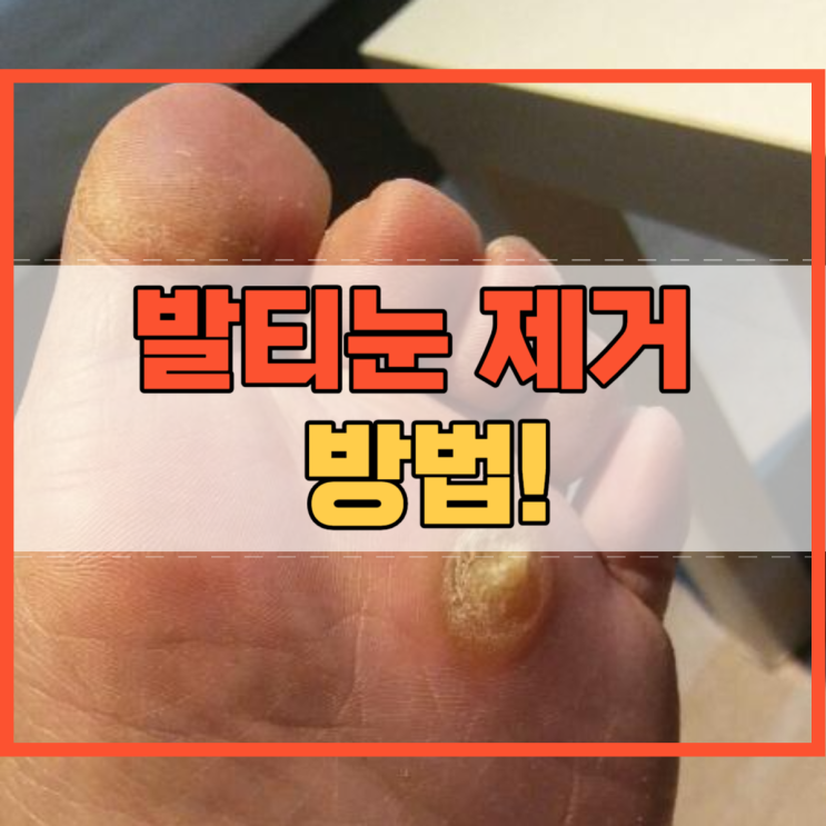  발티눈 제거 방법 알려드릴게요!