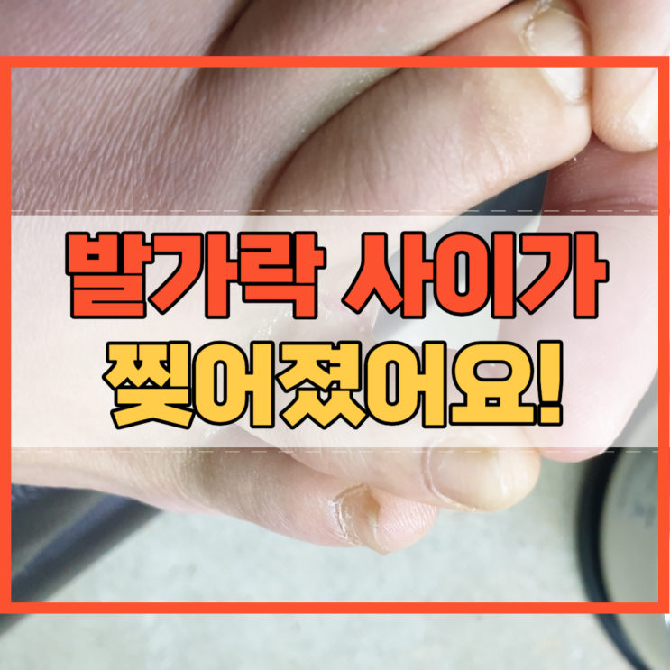  발가락 사이 갈라짐 찢어짐 습진 무좀 건조함이 원인 치료법은?