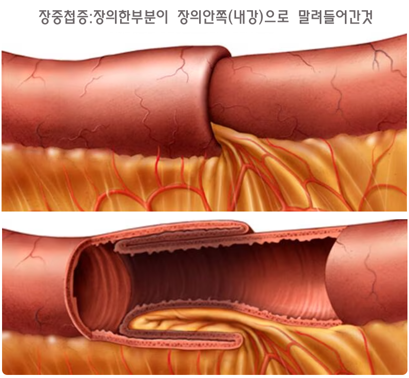 아기 장염 증상 원인 소아 장중첩증 아기 장꼬임 어린이 배아플때
