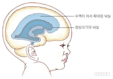 수두증(Hydrocephalus): L-P cath, V-P shunt(뇌실복강단락술), 의학용어 EVD, Burr hole ...