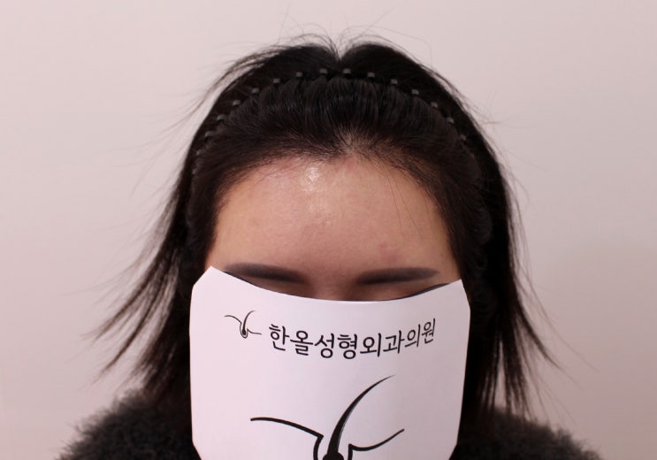  한올성형외과 여성 헤어라인 수술 후 2주 경과