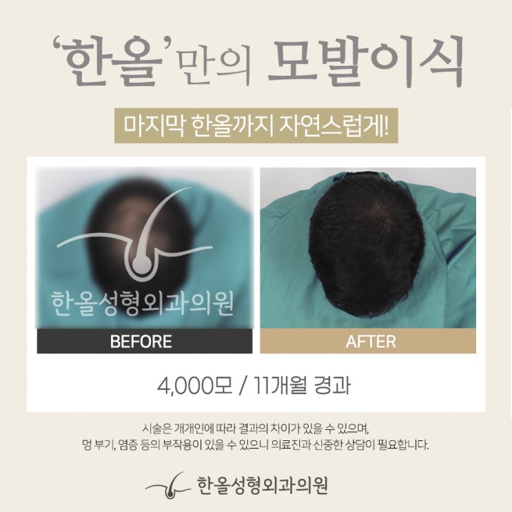  [한올성형외과] 남자 모발이식 전후 - 모발이식 잘하는곳 한올성형외과/비절개모발이식/모발이식비용/정수리모발이식