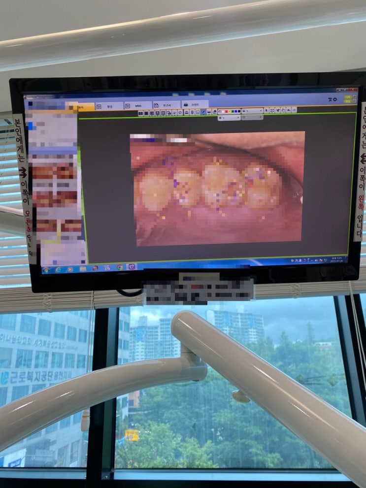  기흥구 치과 : 사이충치 인레이 신경치료 내돈내산 후기 (과잉진료 X)