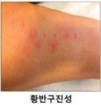  서울도봉구성북구강북구노원구방문요양사/요양보호사 구인파견센터- "빈대 예방 및 방제방법 등 안내"