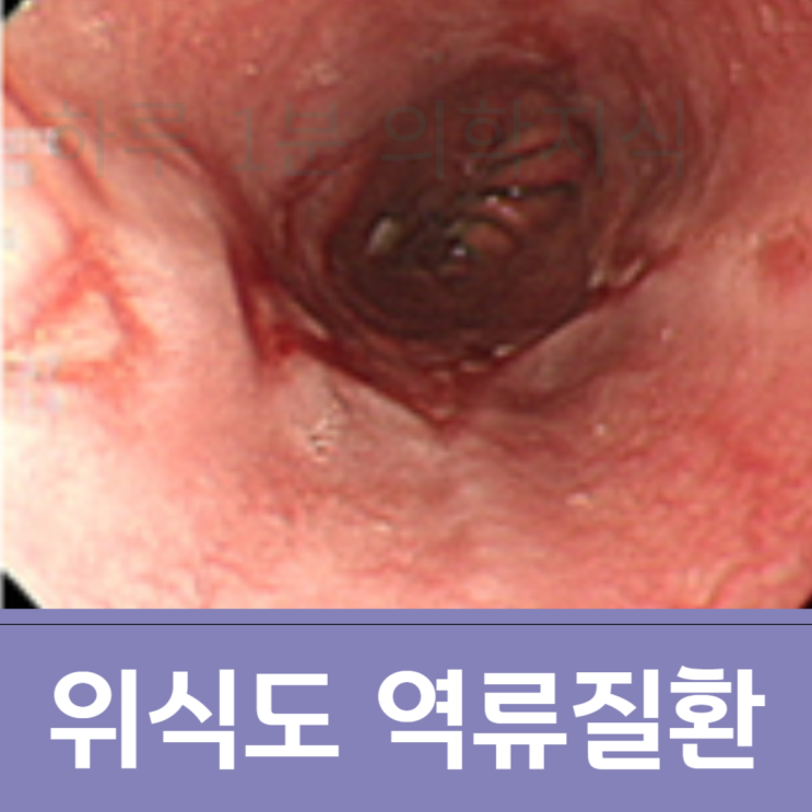  위식도 역류질환을 예방하는 6가지 생활습관