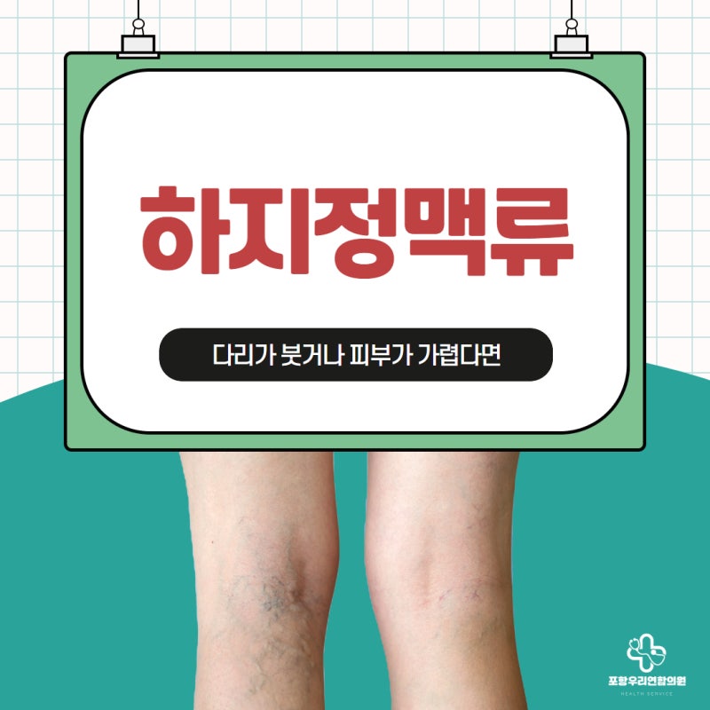 포항하지정맥류, 다리가 붓거나 피부가 가렵다면!?