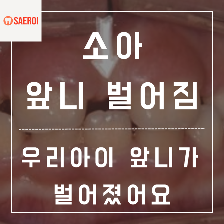  우리아이 앞니가 벌어져서 나와요(소아 앞니 벌어짐)