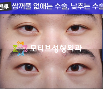 남자 겹쌍꺼풀, 쌍꺼풀없애는수술 재수술편, 실제 환자 재수술 사례 케이스