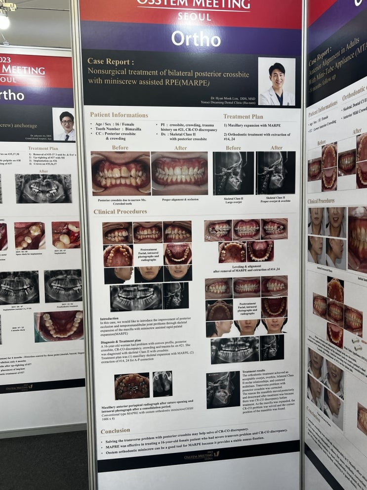 오스템 미팅 2023 포스터 전시 참석, MARPE를 통한 비수술적 상악 확장 치료