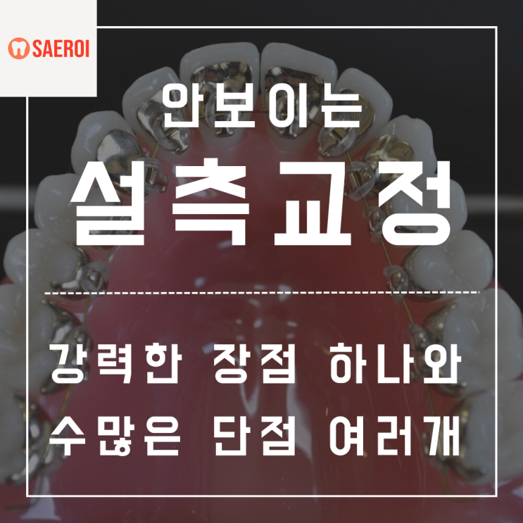  안보이게 교정하는 설측교정의 장점과 단점