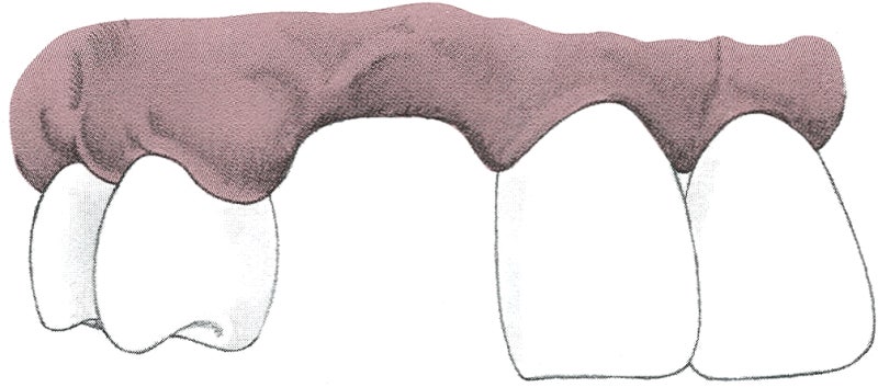 Pontic 폰틱 파닉 정의 종류 치조제 상실의 분류 Pontic 형태 장단점 적응증 : 네이버 블로그