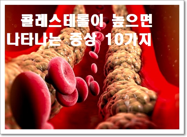  높은 콜레스테롤  수치로 내몸에 나타나는  증상 열가지 알아보기