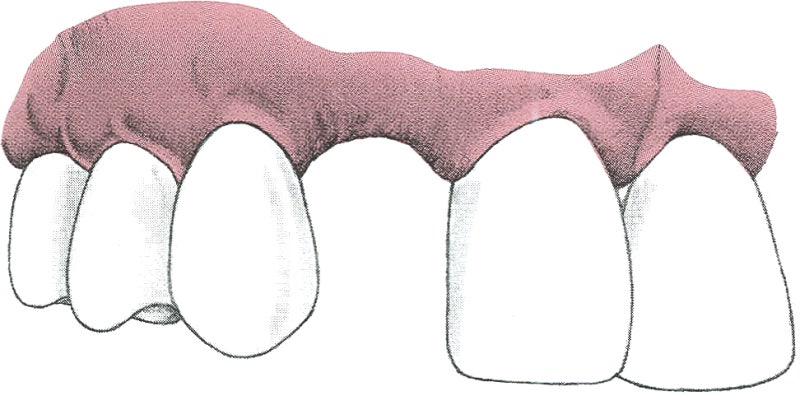 Pontic 폰틱 파닉 정의 종류 치조제 상실의 분류 Pontic 형태 장단점 적응증 : 네이버 블로그