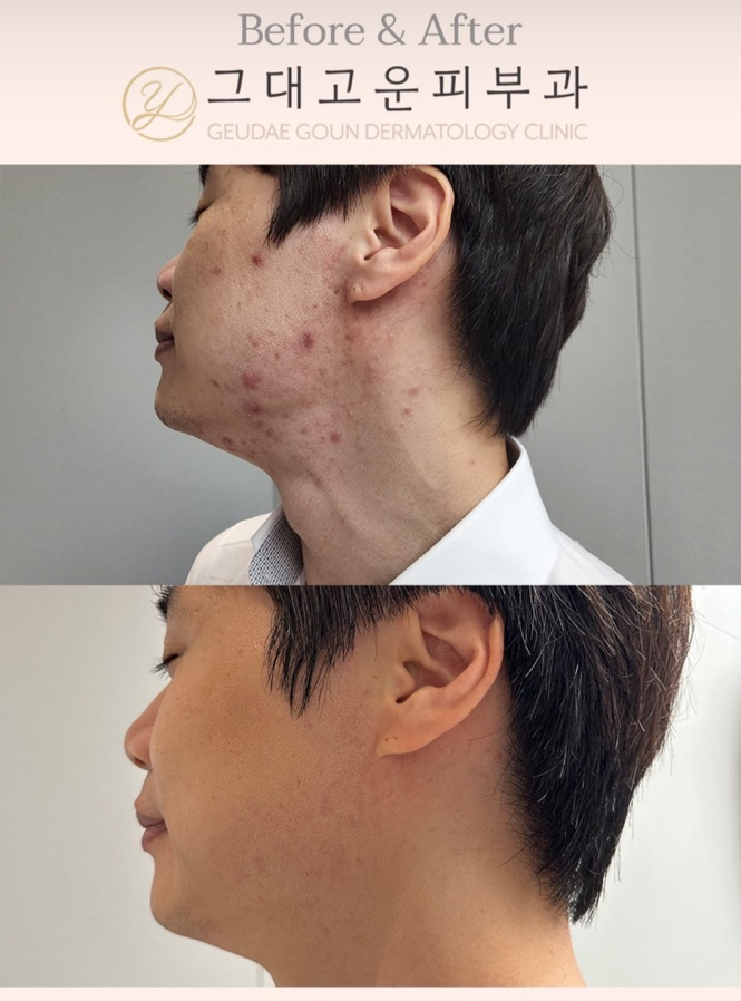 서면 여드름흉터 수백만원 써도 실패하는 이유 서면 여드름흉터 수백만원 써도 실패하는 이유