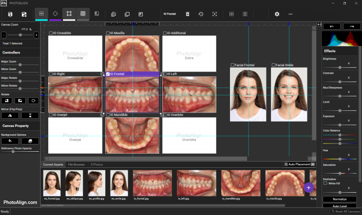 치과에서 촬영한 사진은 어떻게 편집할까? 교정 사진 편집 - 포토얼라인 PhotoAlign