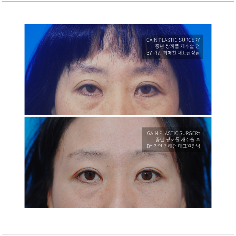 중년쌍꺼풀재수술 눈재수술잘하는곳 리얼후기 [가인성형외과]