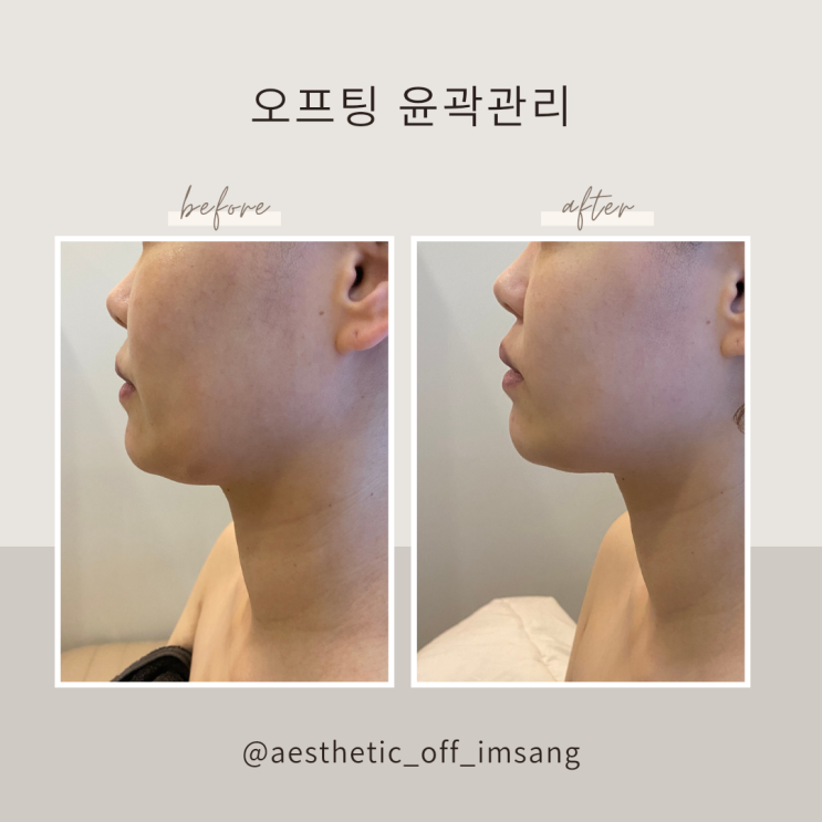  운암동피부관리 에스테틱오프의 오프팅 관리 모아보기