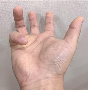  광주방아쇠수지, 수술이 너무 두려워요