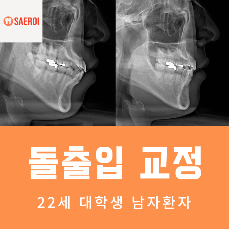  입나온 '돌출입' 발치교정/22세 남자