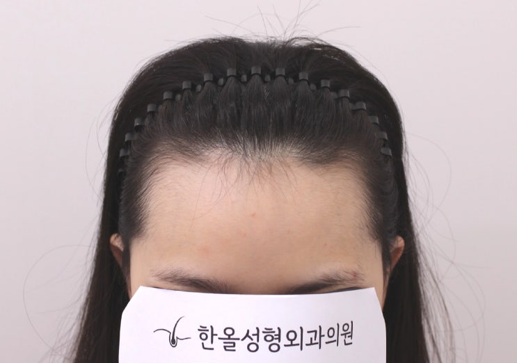  20대 여성 헤어라인 비절개 3000모