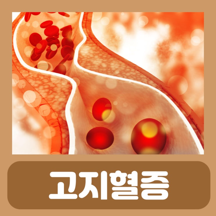 고지혈증에 나쁜 음식 좋은 음식 고지혈증 증상 원인 수치 약 종류